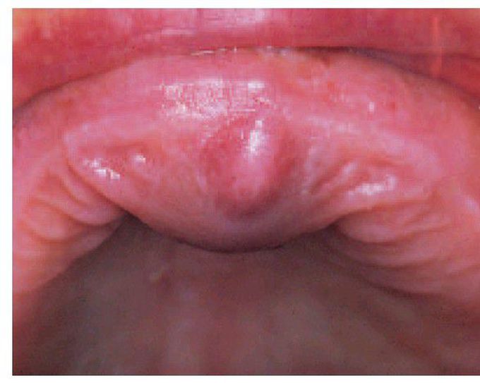 Nasopalatine cyst.