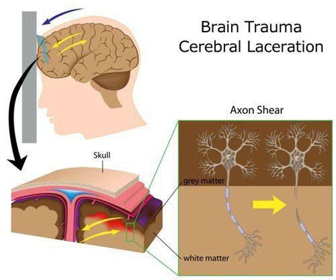 Cerebral laceration causes