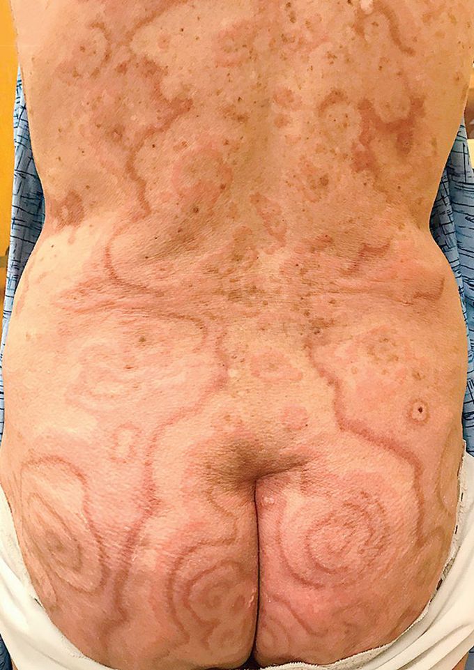 A 73-year-old woman presented to the dermatology clinic with an 11-month history of an evolving pruritic, erythematous rash on her thighs and buttocks. On physical examination she was noted to have polycyclic erythematous plaques. What is the most likely diagnosis?