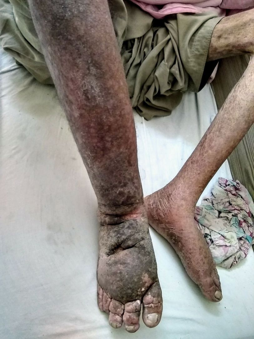 Lymphatic filariasis (Elephantiasis)