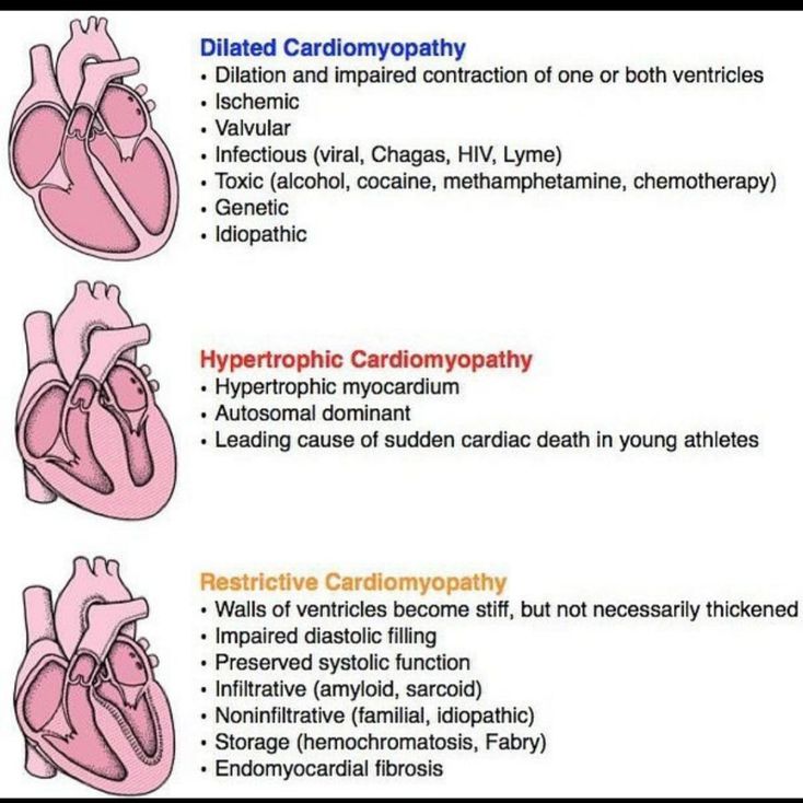 Cardiomyoopathy - MEDizzy