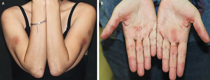 Sleeve Sign and Inverse Gottron’s Papules in Anti-MDA5 Dermatomyositis