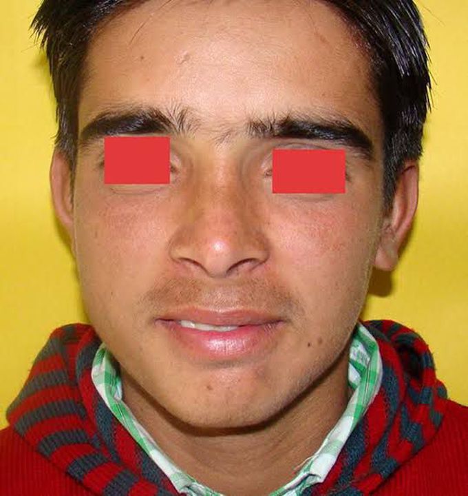 Parry romberg syndrome