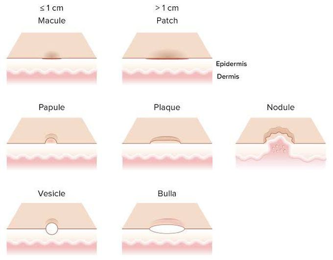 Primary skin lesion