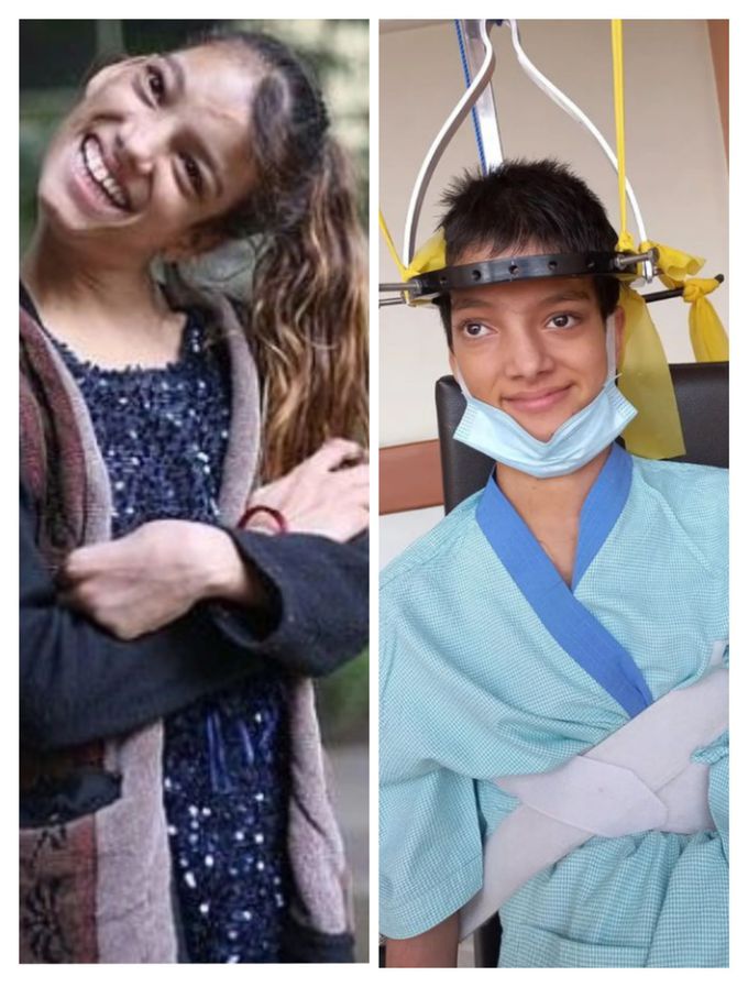 Afsheen Gul before and after surgery