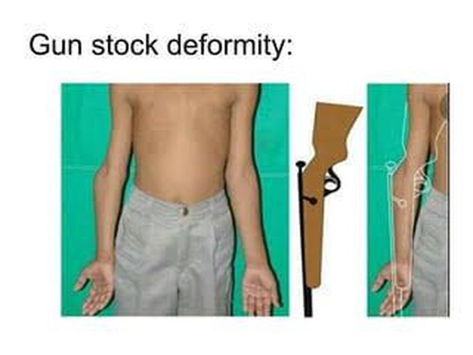 Gunstock deformity