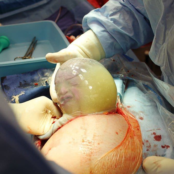 This baby born while still inside the amniotic sac is the most amazing thing you’ll see today! 😄
