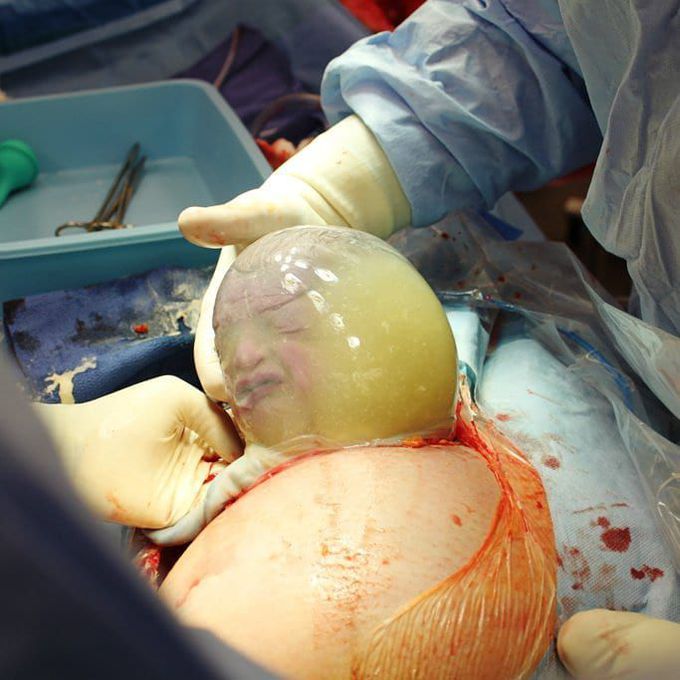 This baby born while still inside the amniotic sac is the - MEDizzy