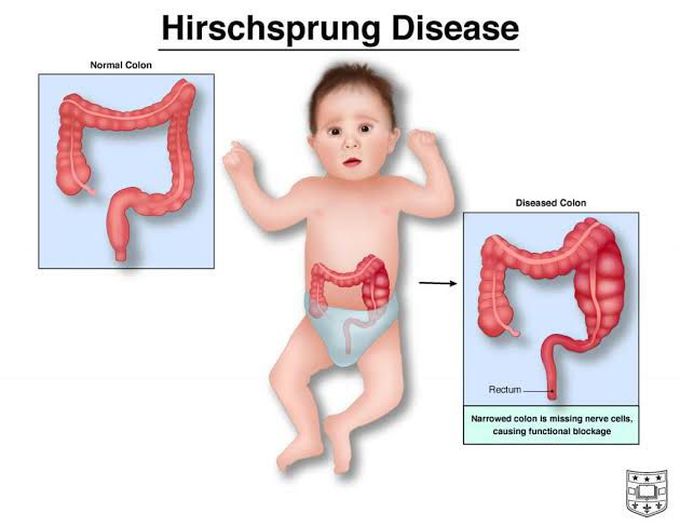 Hirschprung disease