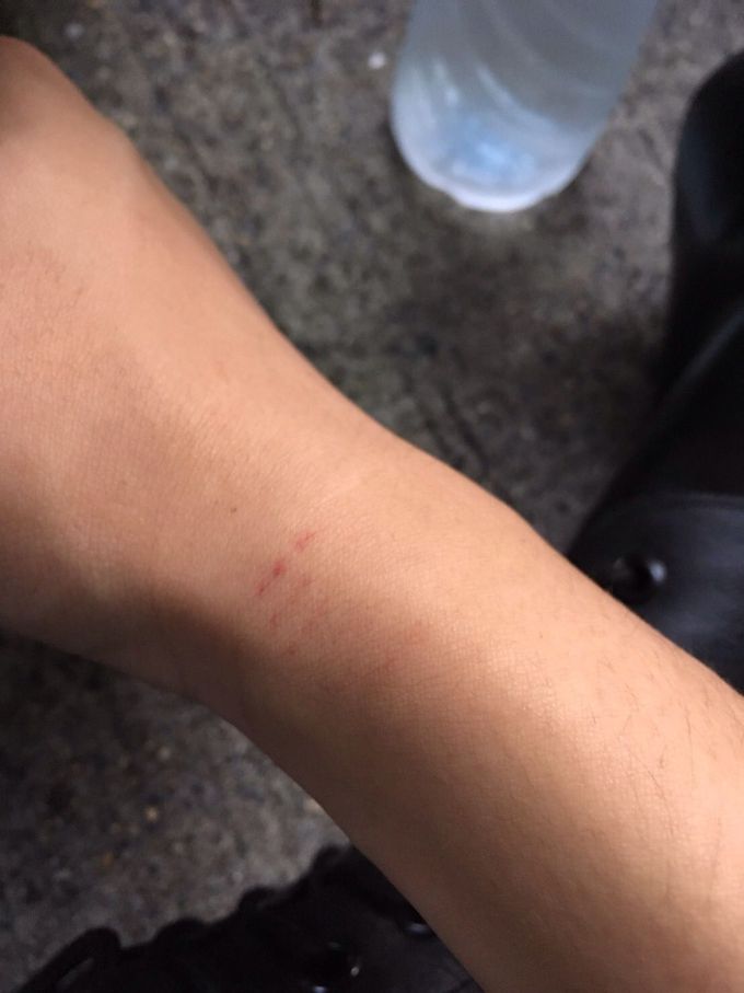 Is this purpura?