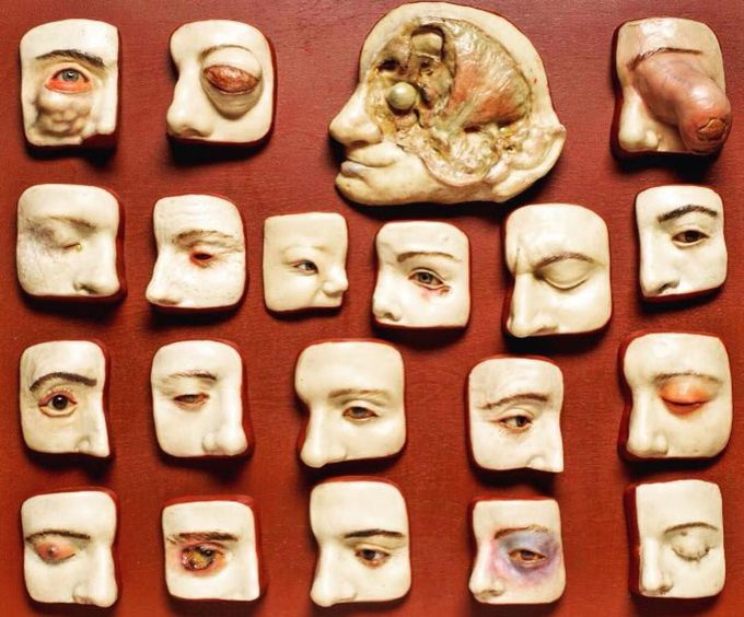 Eye pathology