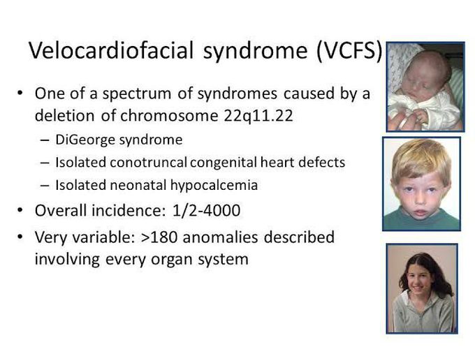 Velocardiofacial syndrome