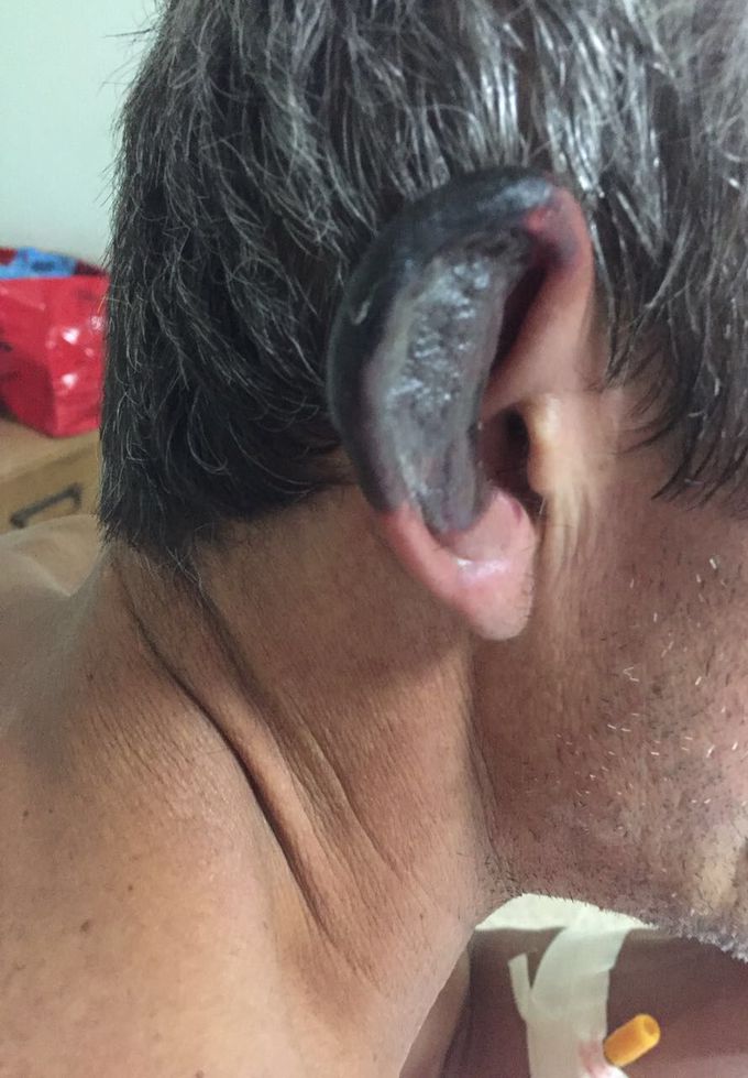 Levamisole-Induced Vasculitis