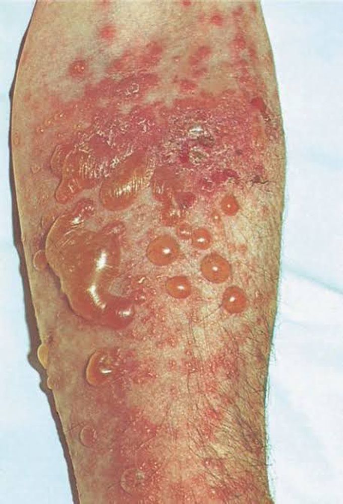 Bullous pemphigoid