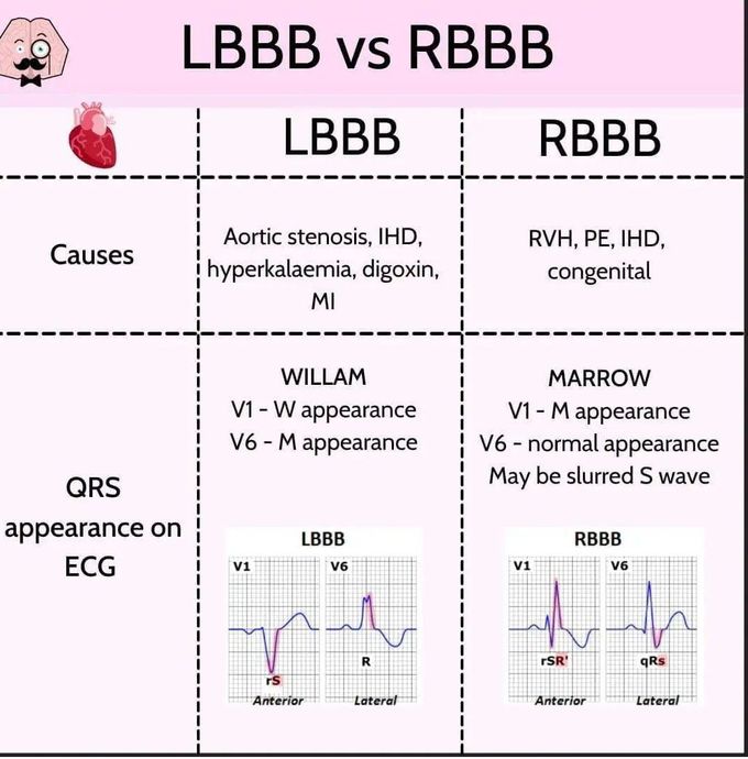 LBBB Vs RBBB