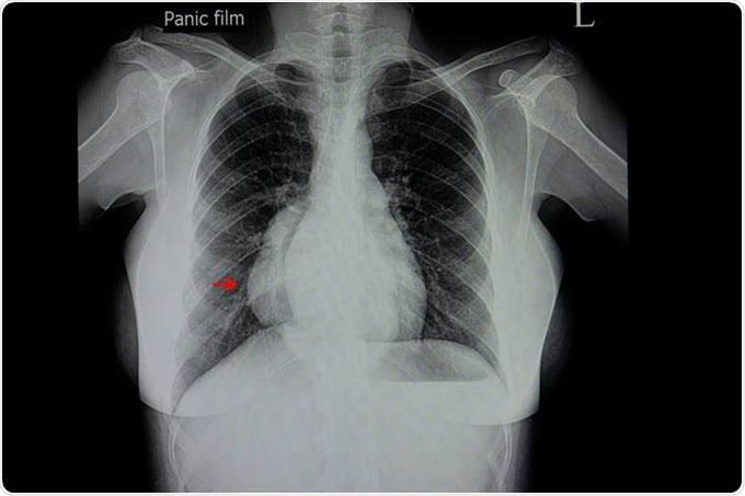 Management of mediastinitis