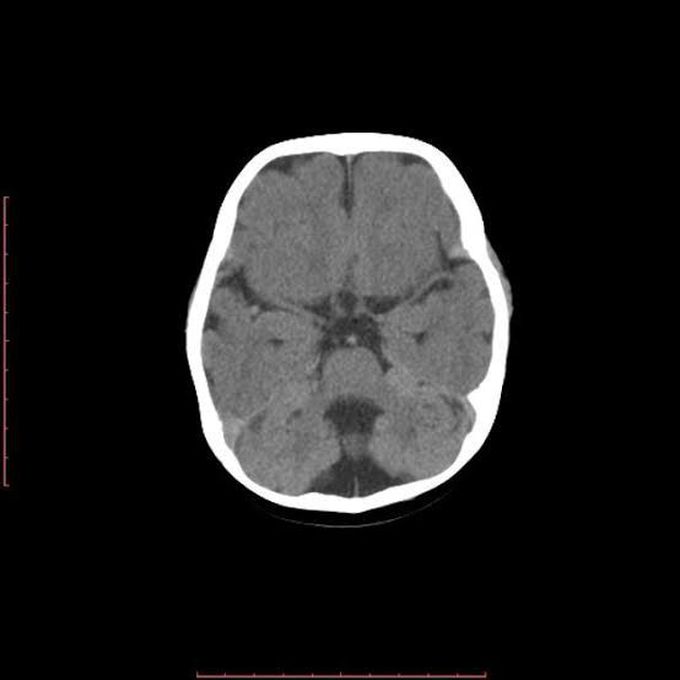 Cerebellar vermis hypoplasia