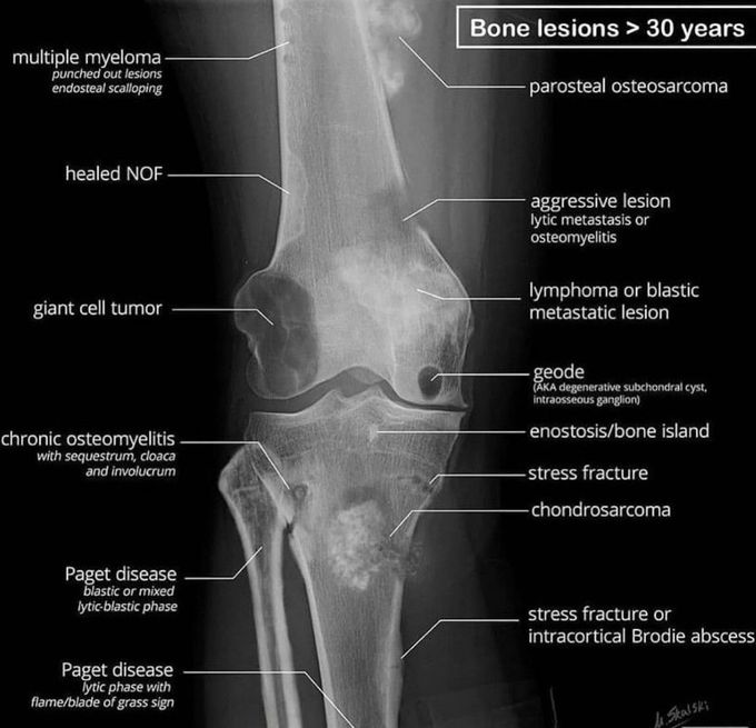 Bone Lesions>30 years