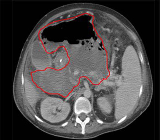 Intra-abdominal Abscess