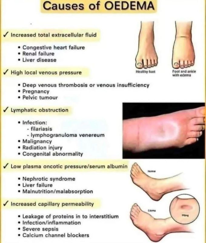 Causes of Edema