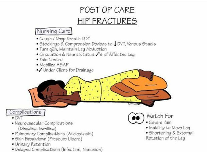 Hip fracture