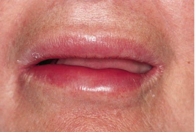Angioedema causes by drug reaction