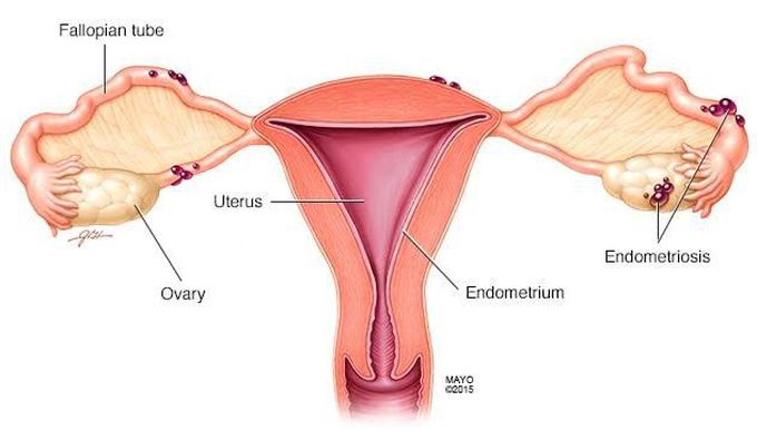 Endometriosis