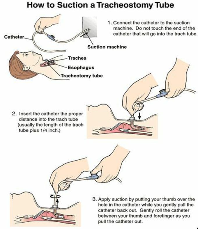 how to inplace a tracheostomy tube
