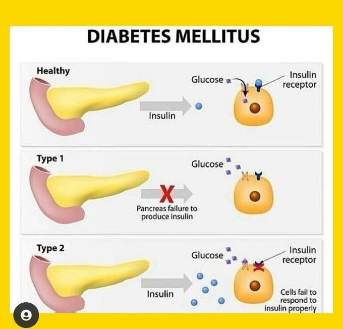Diabetes Mellitus