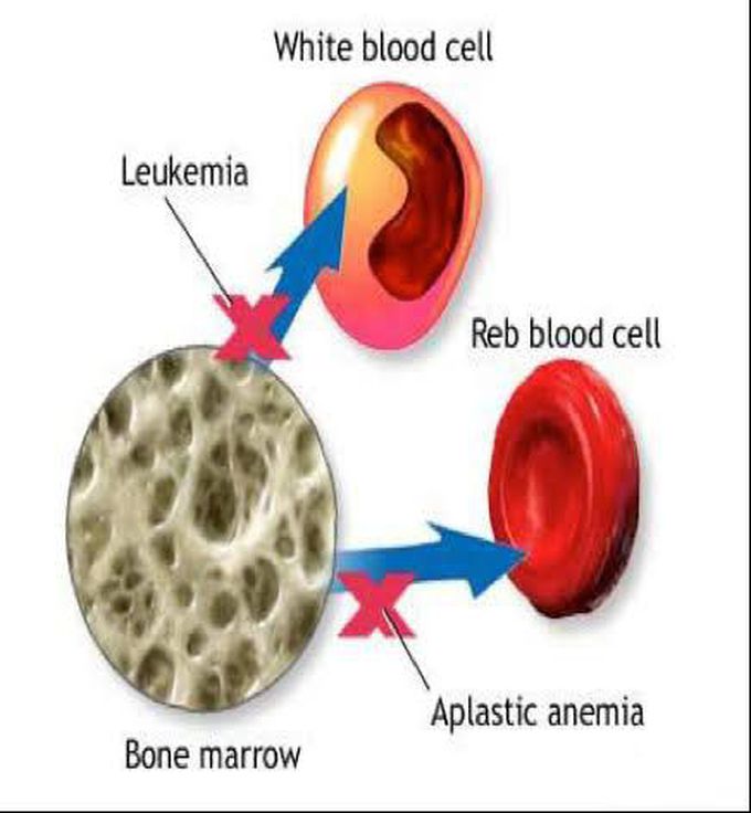 Aplastic anemia