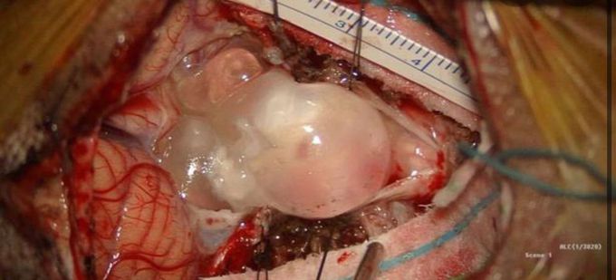 Tapeworm in the Brain (neurocysticercosis)!