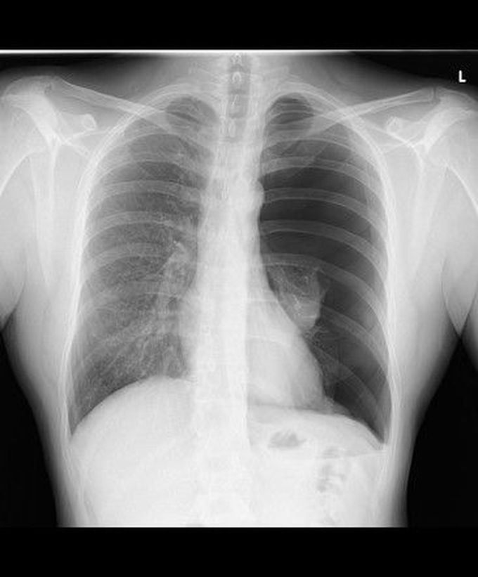 infant pneumothorax x ray