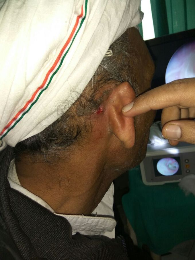 Post auricular fistula