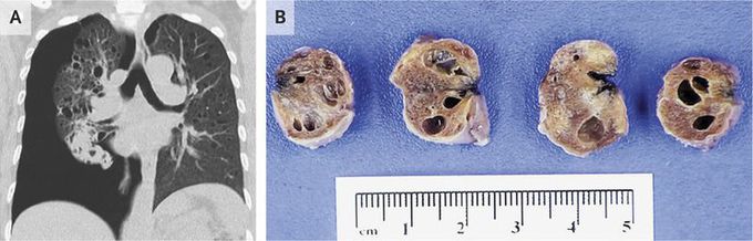 Lymphangioleiomyomatosis