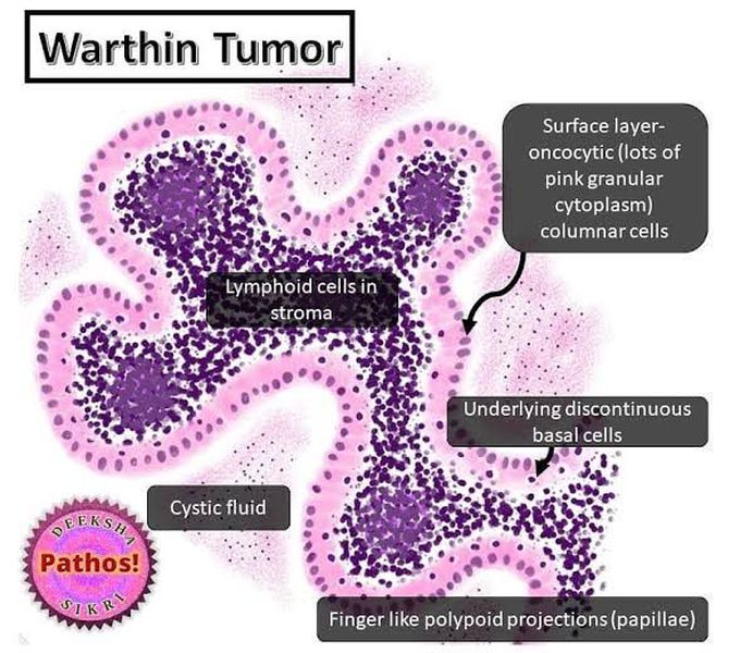 Warthin Tumor