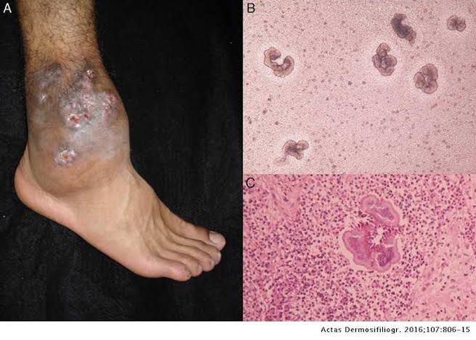 Symptoms of deep mycosis