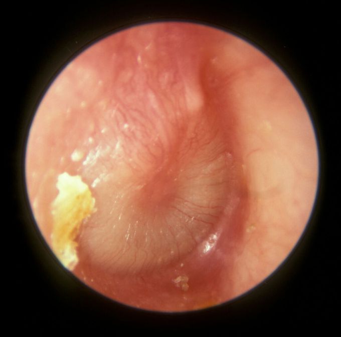 Acute Otitis Media