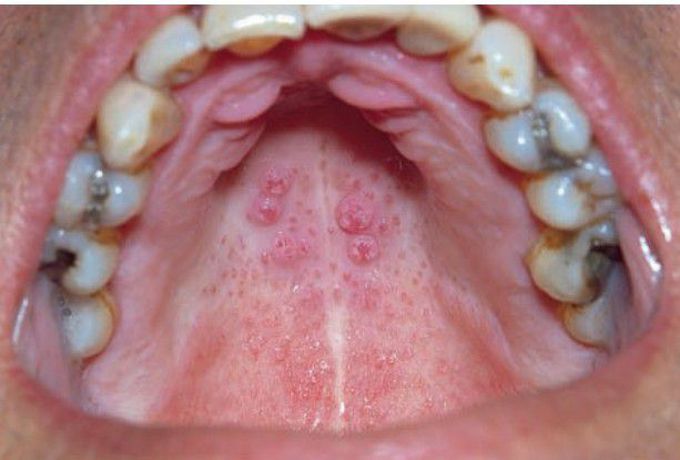 Nicotinic stomatitis