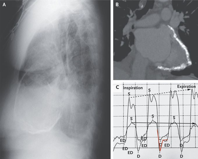 Constrictive Pericarditis