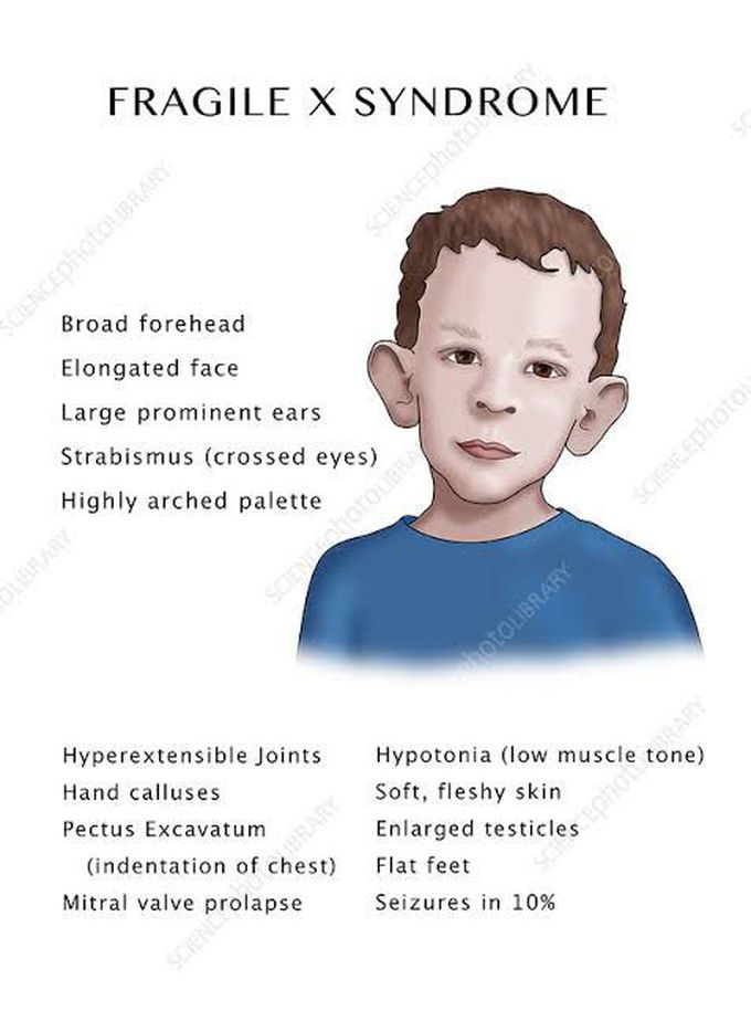 Fragile X syndrome