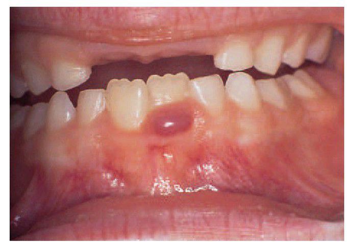 Giant-cell epulis.