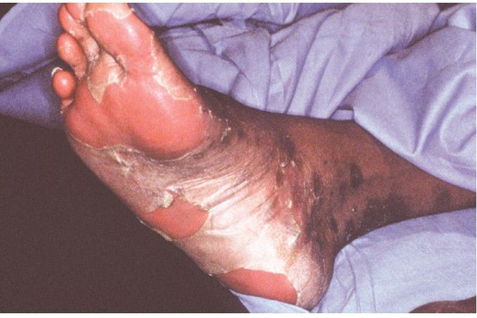 Toxic Epidermal Necrolysis.