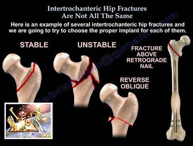 Intertrochanteric Hip Fractures , not the Same - Everything You Need To Know - Dr. Nabil Ebraheim