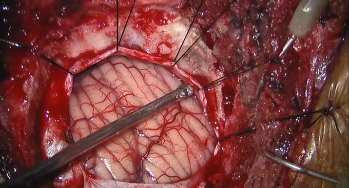 NEUROSURGERY