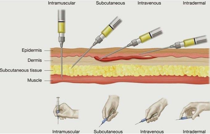 Types of injection