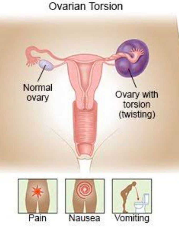 Symptoms of Ovarian torsion