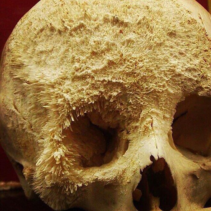 Bone cancer on the skull: Symptoms and more