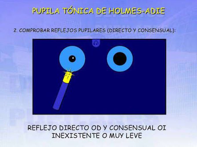 Pupila ADie