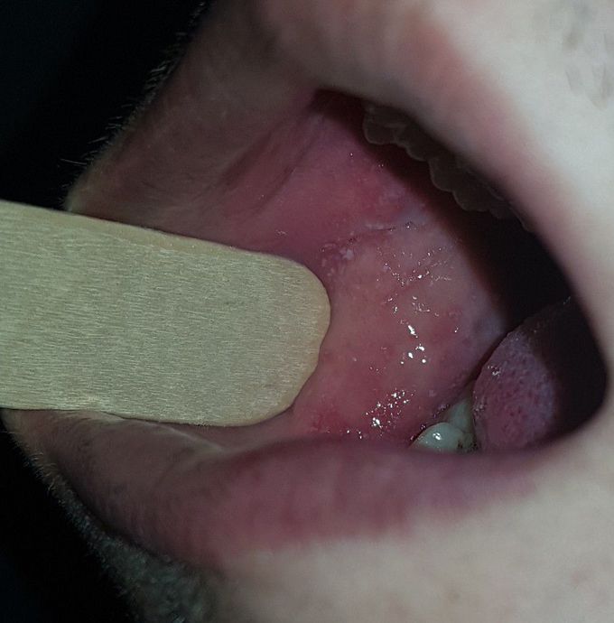 Koplickspots