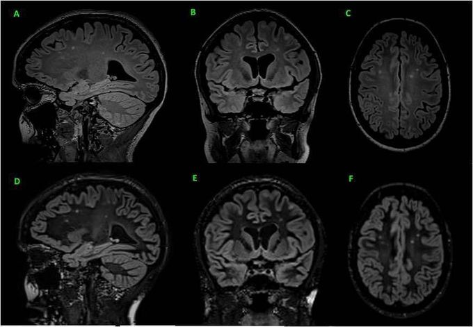 Fig 3D sagittal FLAIR (A) and multiplanar reconstruction in - MEDizzy